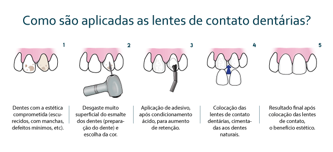 lente de contato dental, fotos, imagens nos dentes