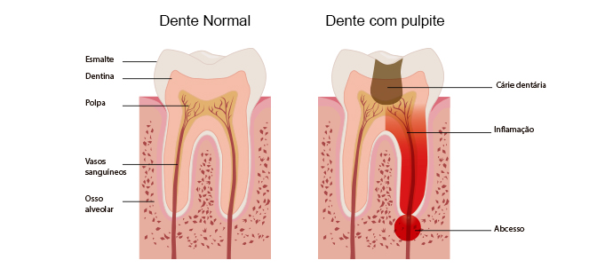 Pulpite (dente Inflamado)