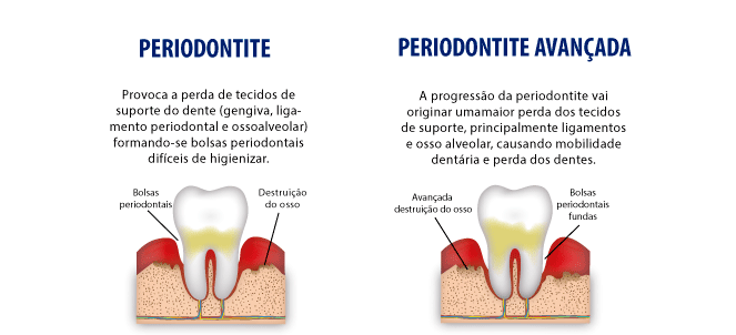 Periodontite fotos, imagens