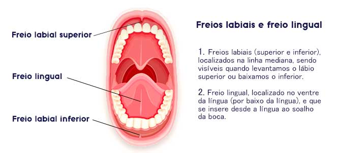 Resultado de imagem para Frenectomia