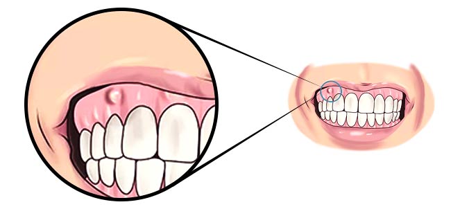 Abcesso dentário - fotos, imagens