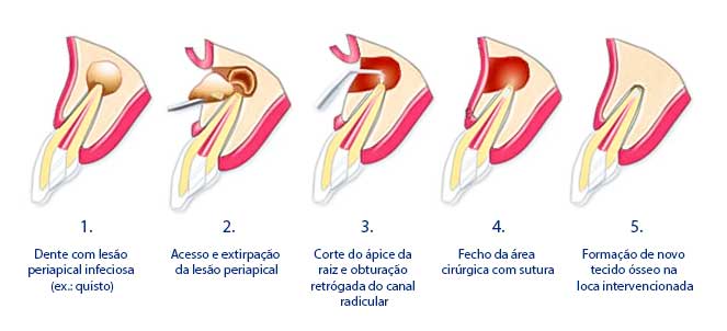 Apicectomia dental, fotos, imagens