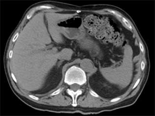 TC ou TAC abdominal superior