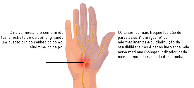 Sindrome do tunel do carpo fotos, imagens