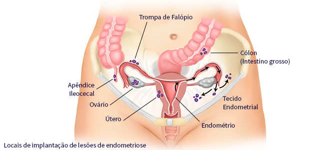 Endometriose