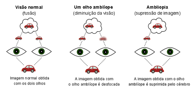 Ambliopia ou olho preguiçoso - o que é, tratamento, tem cura?