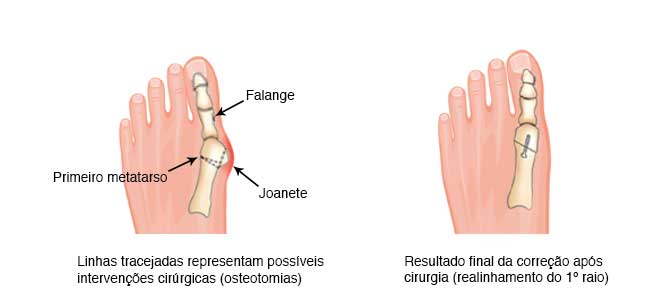 sapato pos operatorio joanete