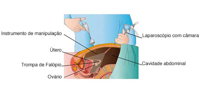 O uso da laparoscopia para a realização das cirurgias de retirada