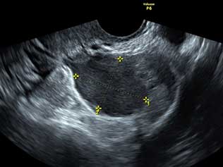 Endometriose - cisto no ovário