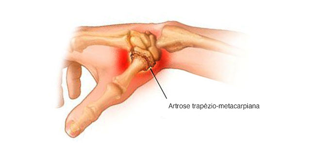 tratament articular vao