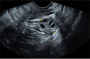 Fase folicular