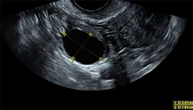 Fase folicular