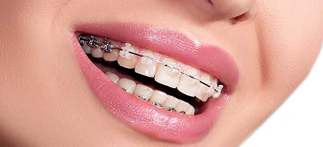 Featured image of post Dente Encavalado Quanto Tempo De Aparelho Esse tipo de aparelho tamb m