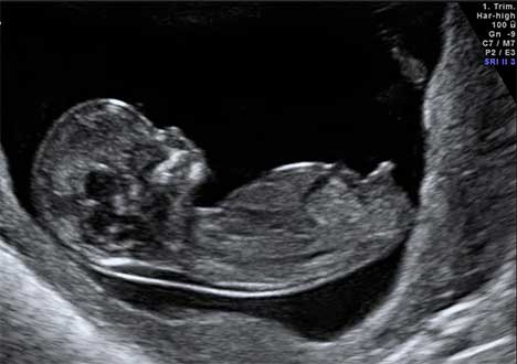 Sexo no primeiro trimestre da gravidez