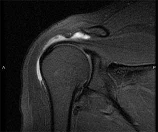 simptomele leziunii ligamentului gleznei unguente din ruperea ligamentelor gleznei