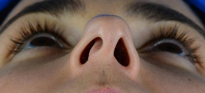 Fotos de cirurgia de desvio de Septo Nasal (nariz)
