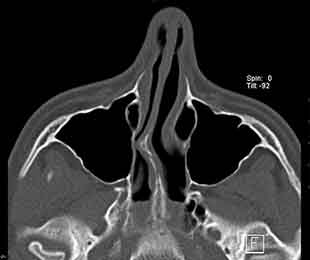 TC do nariz com desvio do septo nasal