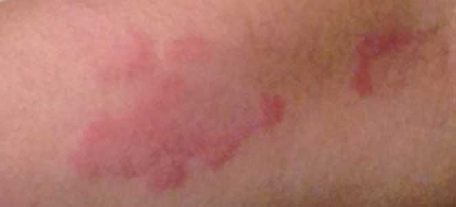 Urticaria