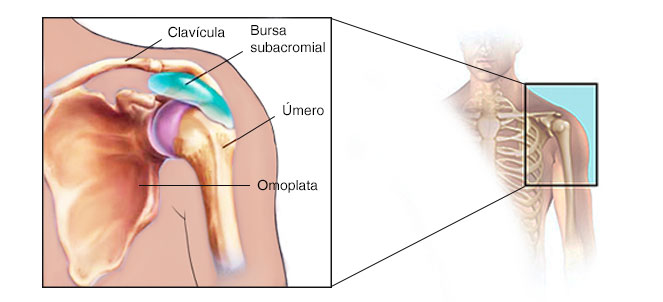 bursita subdeltoidiana)