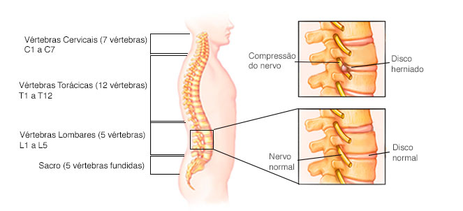 Hernia de disco sintomas