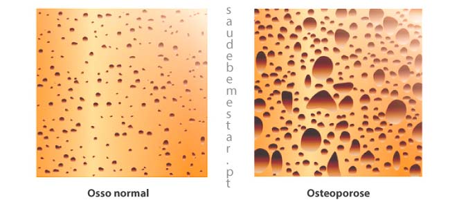 Densitometria óssea