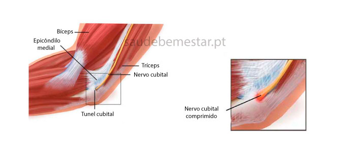 Sindrome do túnel cubital ou ulnar, fotos, imagens