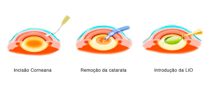 cirurgia de catarata