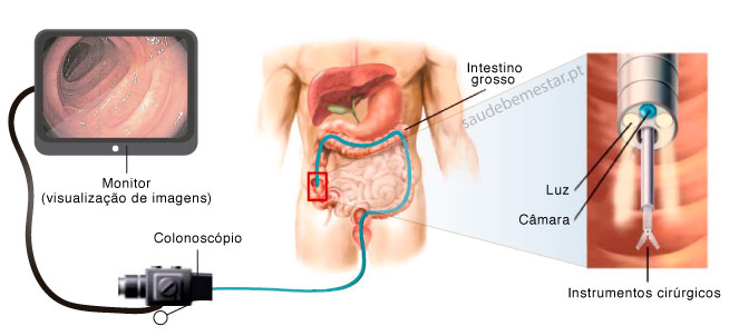 Dieta para hacer colonoscopia