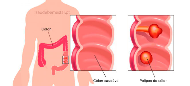 Fotos de pólipos intestinais