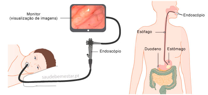 Fotos de Endoscopia digestiva alta