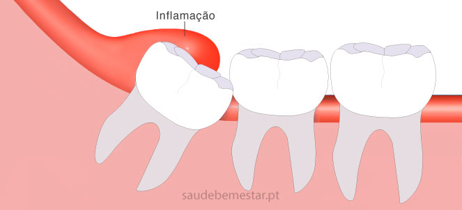 Minha gengiva está inchada e doendo. O que fazer?