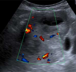 Ecografia abdominal com Doppler