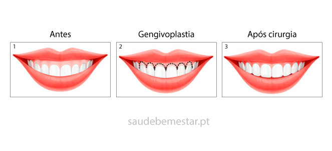 Gengivoplastia e gengivectomia , fotos, imagens
