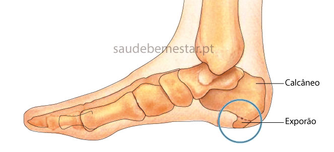 Fotos de esporâo de calcâneo