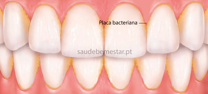 Placa bacteriana fotos, imagens