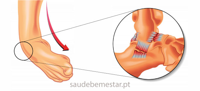 Tornozelo inchado, o que pode ser? 