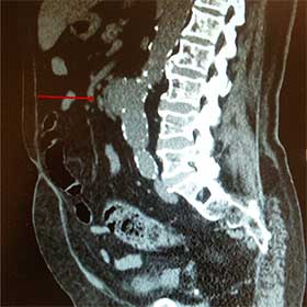 TAC de aneurisma sacular da aorta abdominal