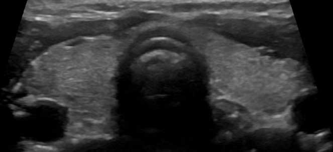 Fotos de ecografia tiroideia ou ecografia da tiróide