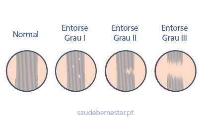 Graus do entorse do tornozelo