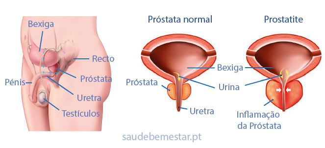 prostata inflamada cronica