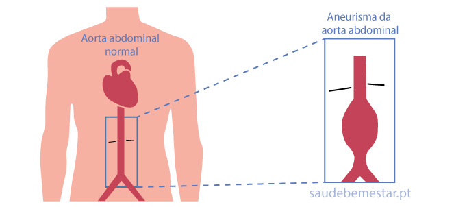 Fotos de aneurisma da aorta abdominal