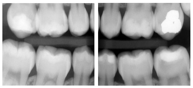 Radiografia interproximal (rx bite wing), fotos, imagens