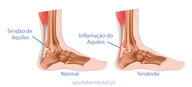 Tendinite de aquiles