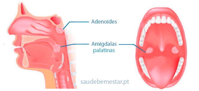 Amigdalectomia - Cirurgia para tirar as amígdalas.