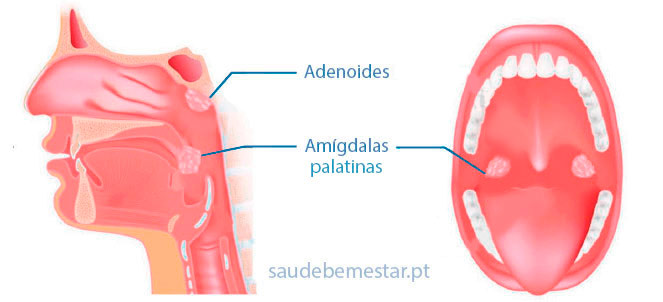 Fotos de tipos de amigdalite