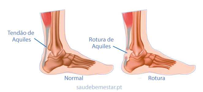 Atacante Rodrigão rompe tendão de Aquiles e passa por cirurgia