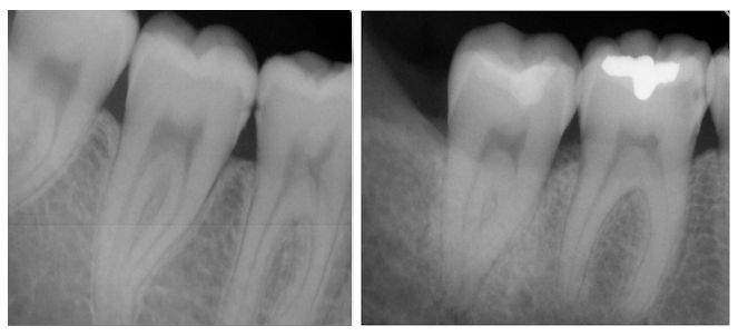 Radiografia periapical, fotos, imagens