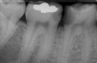 Raio X (RX) de dente com cárieno dente