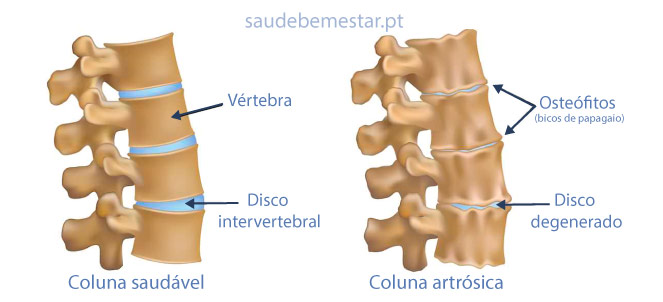 artrite degenerativa da coluna vertebral)