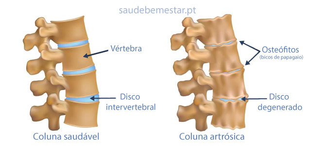 Fotos de espondilose